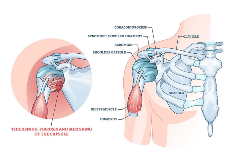 Frozen shoulder treatment in Goregaon