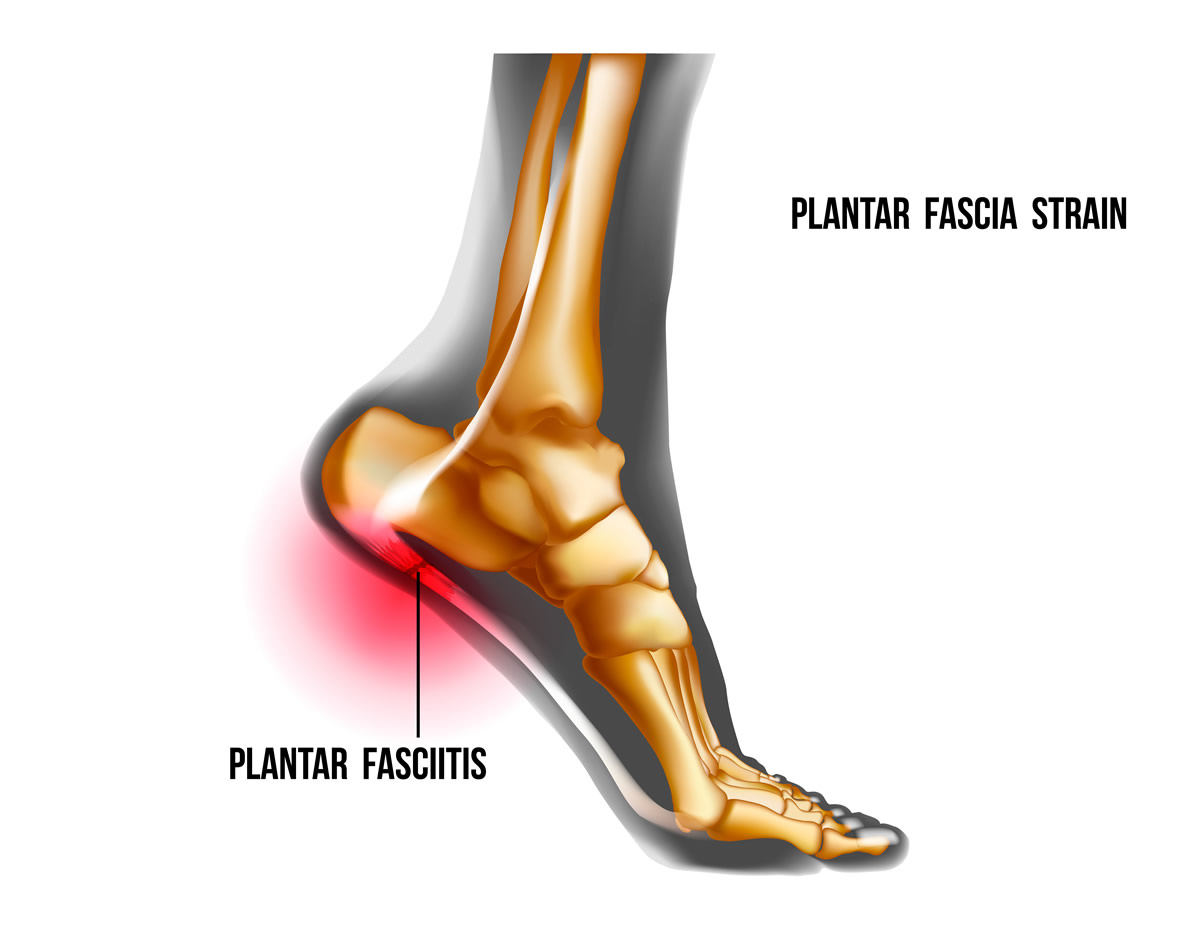 Plantar Fasciitis treament in goregaon